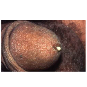 thé de la gonorrhée : infusion naturelle pour le confort urinaire et génital