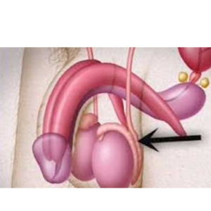 thé de la gonorrhée : infusion naturelle pour le confort urinaire et génital